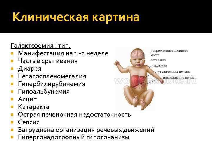 Галактоземия - что это, описание, признаки, симптомы ~