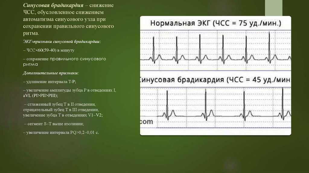 Аритмия – лечение, симптомы и причины аритмии сердца | фнкц фмба россии