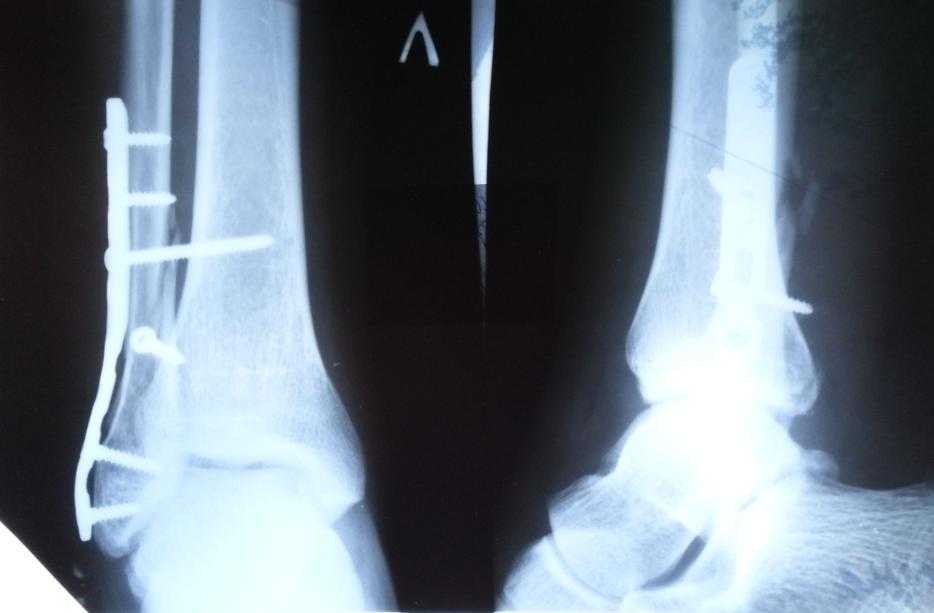 Перелом н 3. Перелом н3 малой берцовой кости. Перелом 3 малой берцовой кости. Перелом малый малый берцовой кости. Перелом малоберцовой кости на ноге.