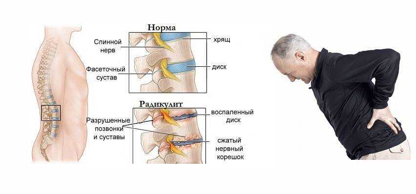 Грыжа позвоночника крестцово поясничного. Люмбалгия поясничного крестцового отдела. Хроническая люмбалгия поясничного отдела позвоночника. Люмбалгия пояснично крестцового отдела позвонка. Что такое люмбалгия пояснично-крестцового отдела позвоночника.