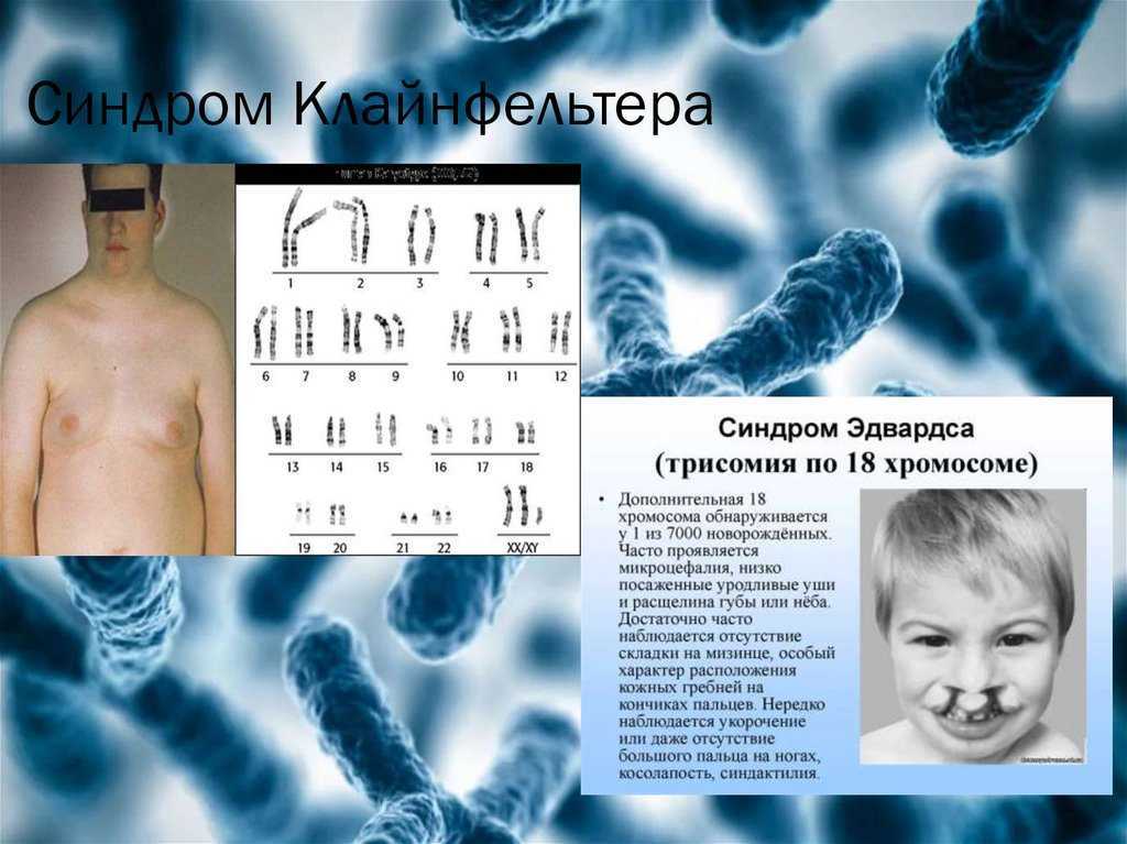 Xxy хромосома. Клайнфельтер хромосомы. Синдром Клайнфельтера 47 xxy. Синдром Клайнфельтера хроматин. Синдром Клайнфельтера трисомия по.
