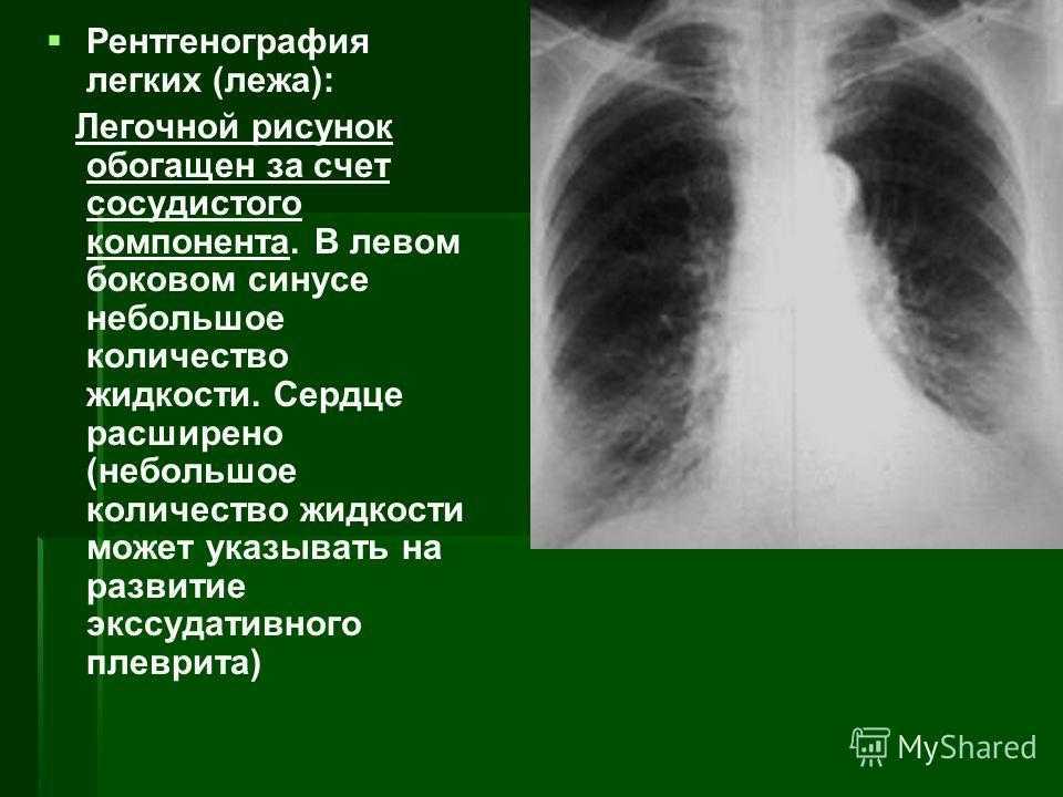 Легочный рисунок обогащен в прикорневых зонах с обеих сторон