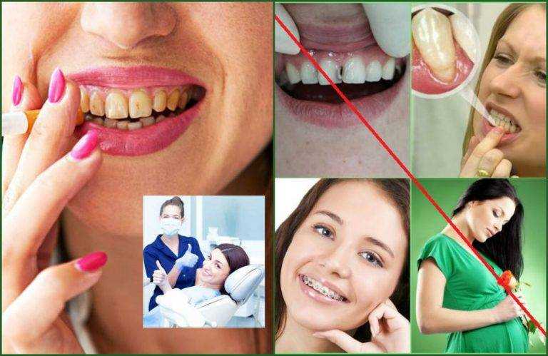 Безопасное отбеливание зубов
