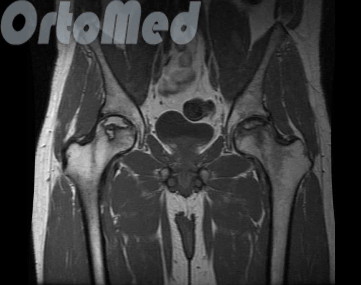Перитрохантерит тазобедренного сустава. Асептический некроз бедренной кости кт. Асептический некроз бедренной кости мрт. Асептический некроз мрт. Мрт асептический некроз головок бедренных костей.