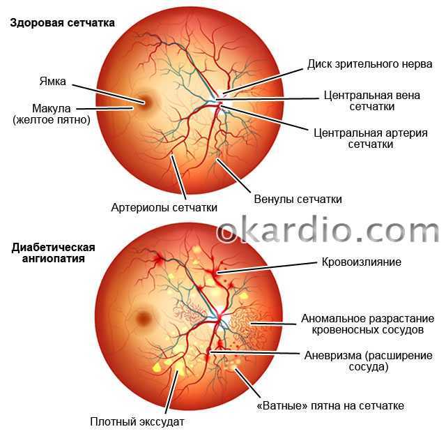 Ангиопатия сосудов сетчатки что это. Ангиопатия и ретинопатия сетчатки. Гипертоническая ангиопатия и ретинопатия. Диабетическая офтальмопатия глазное дно. Гипертоническая ангиопатия сетчатки диагноз.