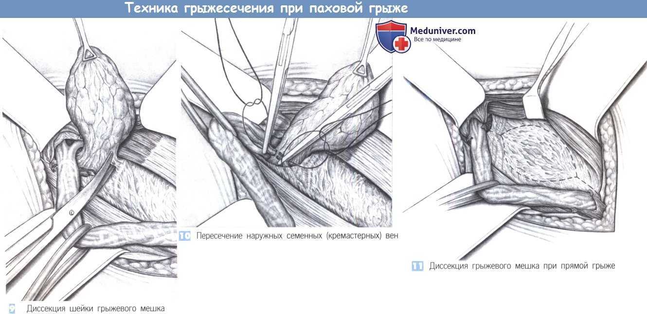 Чем опасна паховая грыжа?