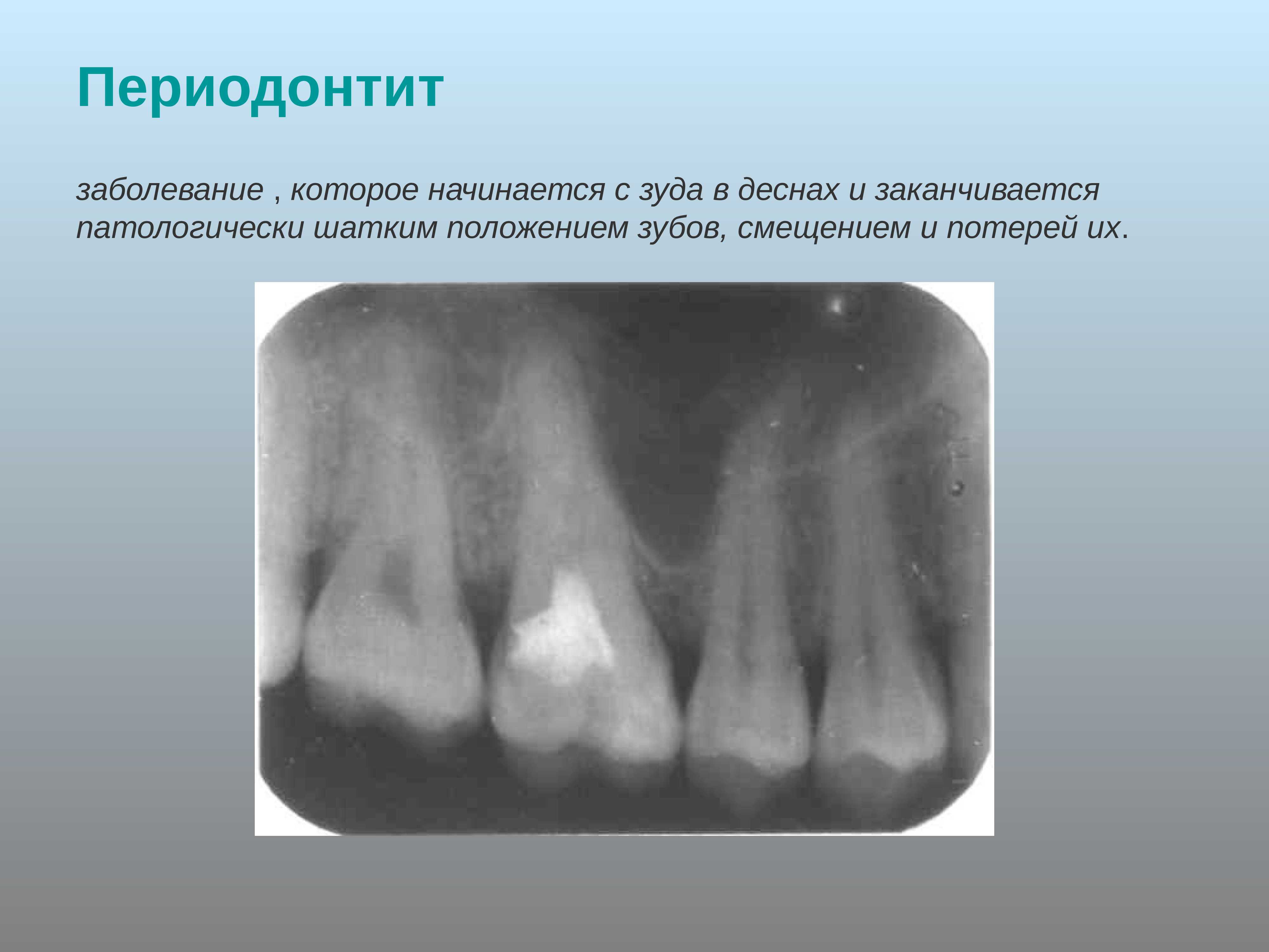Периодонтит 4-корневой зуб