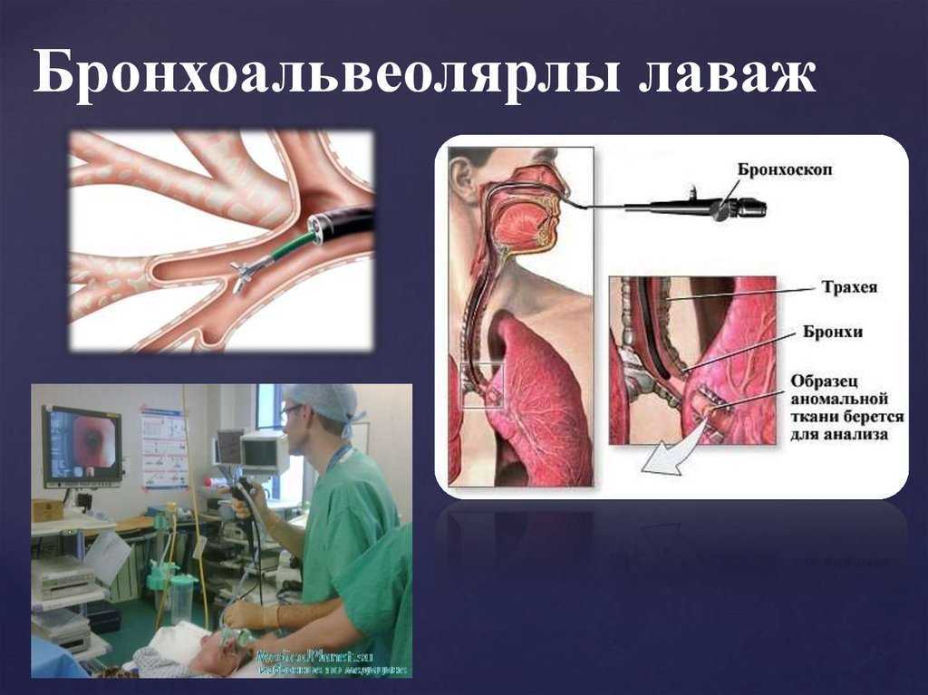 Бронхоскопия: что это такое, для чего делают, как проводится у взрослого человека, как проходит у ребенка, лечебный бронхоальвеолярный лаваж, обзор отзывов пациентов