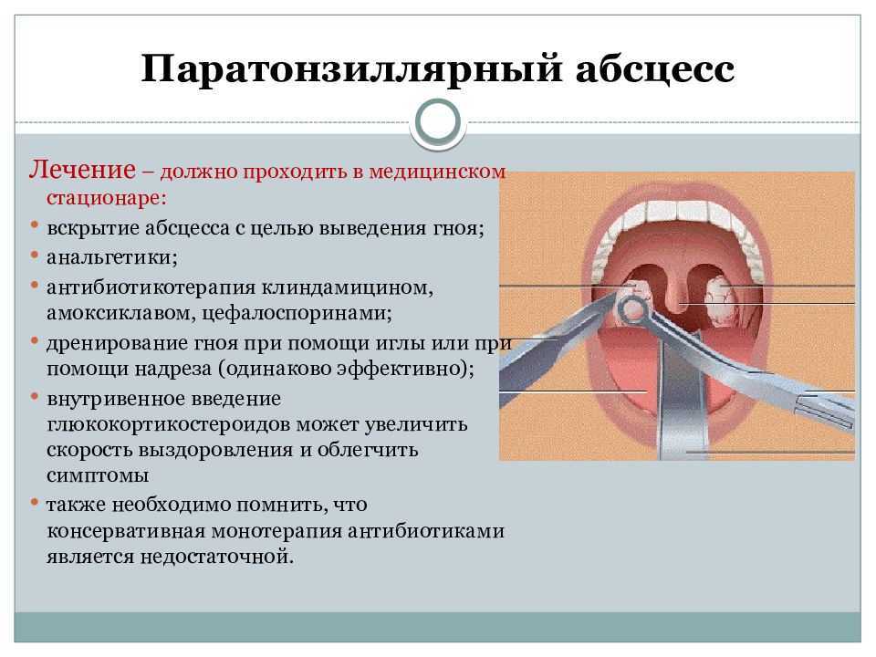 Паратонзиллярный абсцесс локальный статус карта вызова смп