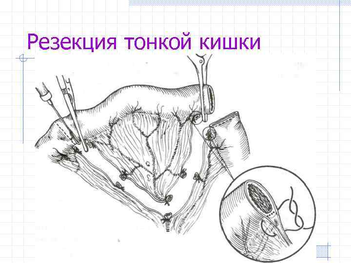 Синдром раздраженного кишечника: признаки, симптомы, лечение - медком