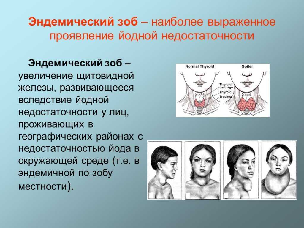 Презентация на тему щитовидной железы