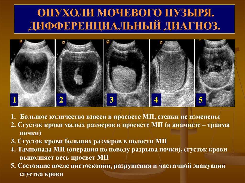 Инфекции мочевыводящих путей: симптомы, причины, факторы риска и диагностика